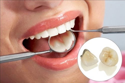 Bọc răng sứ kim loại thường - Các thông tin cơ bản 2