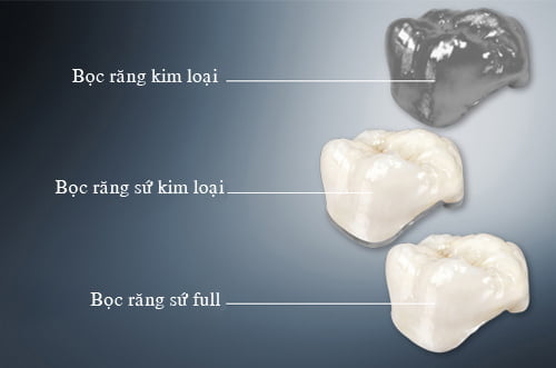 Bọc răng sứ kim loại thường - Các thông tin cơ bản 4