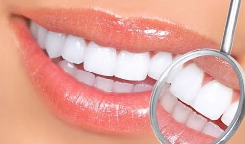 Bọc răng sứ là gì? Quy trình thực hiện theo tiêu chuẩn 1
