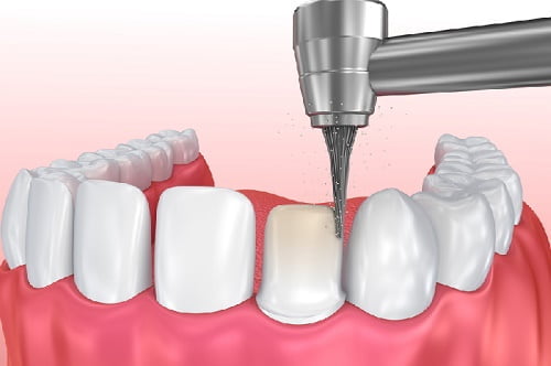 Bọc răng sứ là gì? Quy trình thực hiện theo tiêu chuẩn 3