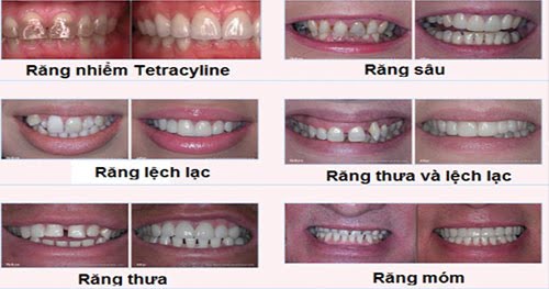 Bọc răng sứ ở đâu đẹp? 3 tiêu chí lựa chọn bạn nên biết 2 Bọc răng sứ ở đâu đẹp? 3 tiêu chí lựa chọn bạn nên biết 2