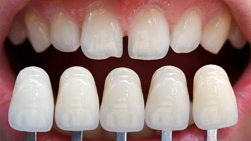 Dán răng sứ veneer - Các bước thực hiện chuẩn 2