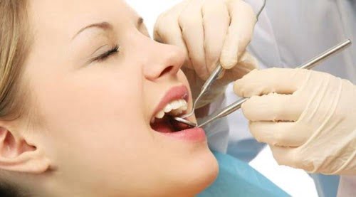 Dán răng sứ veneer - Các bước thực hiện chuẩn 3