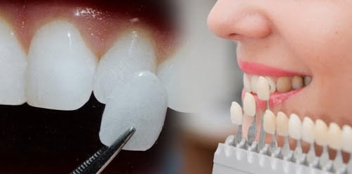 Dán răng sứ veneer - Các bước thực hiện chuẩn 4
