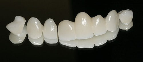 Bọc răng sứ zirconia là gì? Thực hiện thế nào? 1