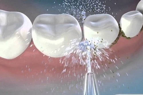 Cạo vôi răng ở đâu tốt? 5 lưu ý khi cạo vôi răng 3 Cạo vôi răng ở đâu tốt? 5 lưu ý khi cạo vôi răng 3
