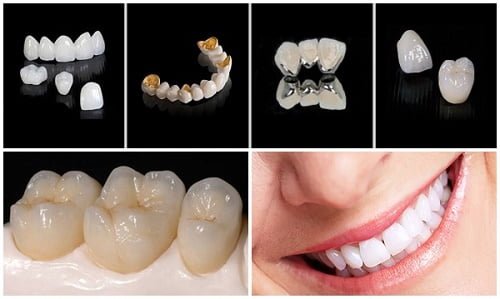Chụp răng sứ giá bao nhiêu? Áp dụng cho trường hợp nào? 2