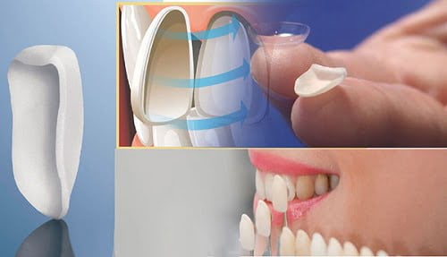 Dán răng sứ có bền không? Thực hiện khi nào? 1 Dán răng sứ có bền không? Thực hiện khi nào? 1