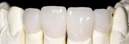 Giá bọc răng sứ zirconia nhiều người muốn tìm hiểu 2