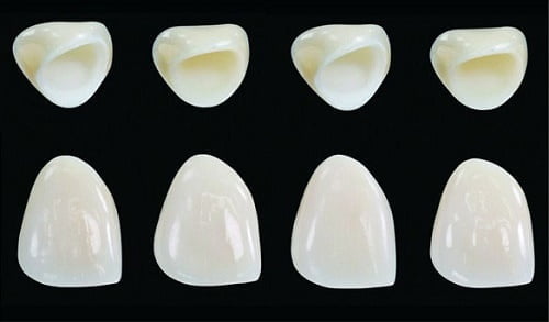 Giá làm răng sứ venus chuẩn nhất tại nha khoa 2019 2 Giá làm răng sứ venus chuẩn nhất tại nha khoa 2019 2