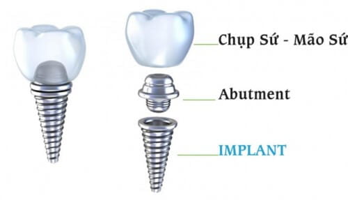Giá răng sứ implant cho răng hàm như thế nào? 1 Giá răng sứ implant cho răng hàm như thế nào? 1