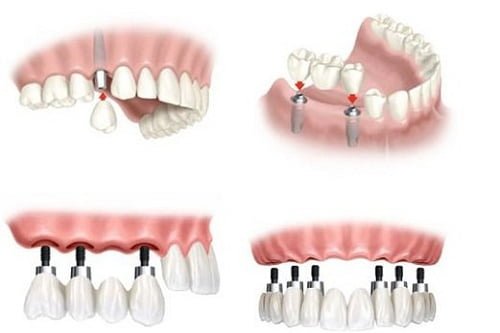 Giá răng sứ implant cho răng hàm như thế nào? 2