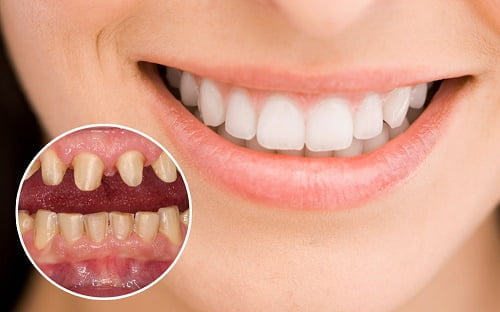 Trường hợp bọc răng sứ cho răng móm hiệu quả 2