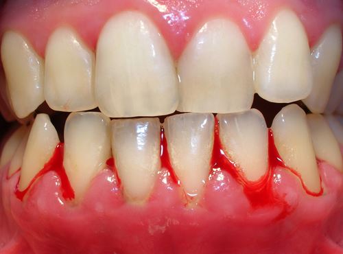 Lấy cao răng có đau hay không? Tìm hiểu cách thực hiện 2 Lấy cao răng có đau hay không? Tìm hiểu cách thực hiện 2
