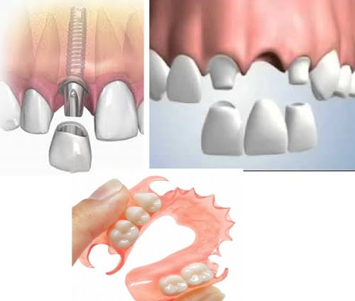 Trồng răng giả có đau không? Có gây biến chứng gì không? 2 Trồng răng giả có đau không? Có gây biến chứng gì không? 2