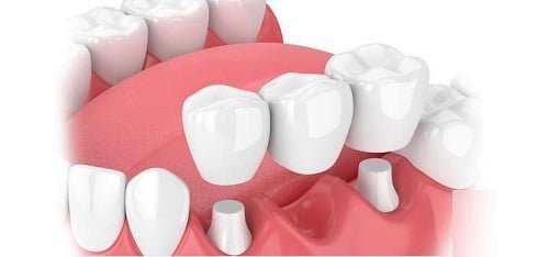Trồng răng vĩnh viễn an toàn hiệu quả-2