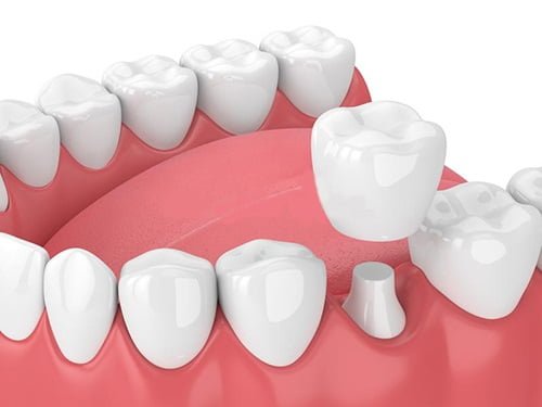 Trồng răng vĩnh viễn an toàn hiệu quả-3