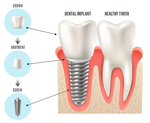 Trồng răng vĩnh viễn an toàn hiệu quả-4 Trồng răng vĩnh viễn an toàn hiệu quả-4