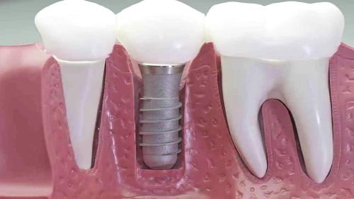Cấy ghép răng implant có tốt không? Thông tin cần tìm hiểu 1