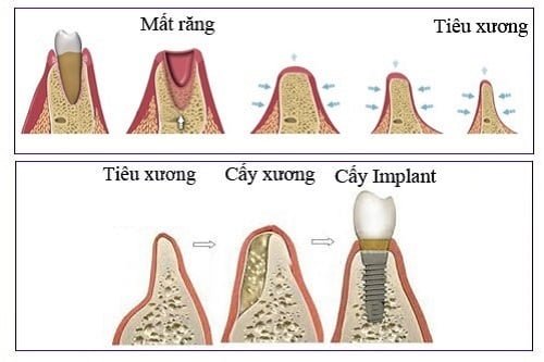 Nâng xoang hàm trong cấy ghép implant 1