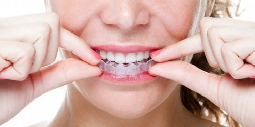 Tẩy trắng răng bằng máng có tốt không? Tìm hiểu ngay 1