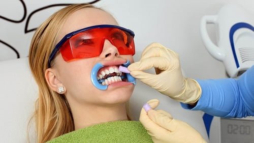 Tẩy trắng răng bằng máng có tốt không? Tìm hiểu ngay 3