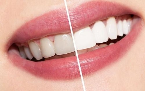Tẩy trắng răng xong có được đánh răng không? Chuyên gia giải đáp 1