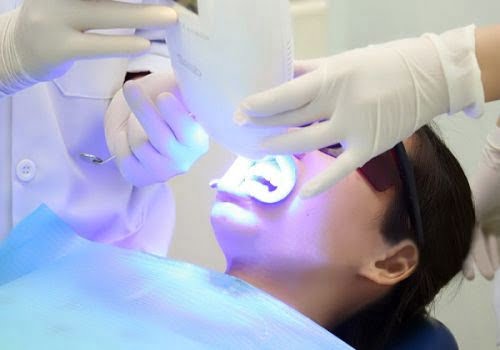 Tẩy trắng răng xong có được đánh răng không? Chuyên gia giải đáp 2