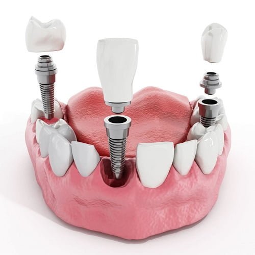 Trồng răng có ảnh hưởng gì không? Tìm hiểu ngay 1