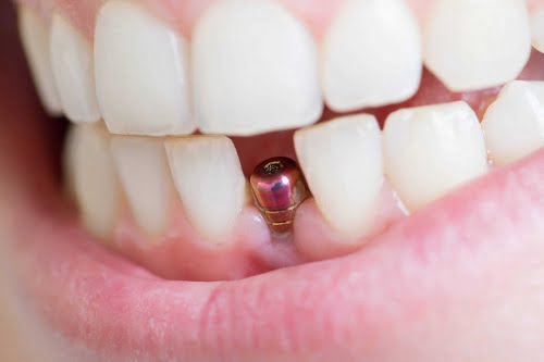 Trồng răng có ảnh hưởng gì không? Tìm hiểu ngay 2