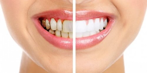 Bột tẩy trắng răng eucryl có tốt không? Thực hư ra sao? 4
