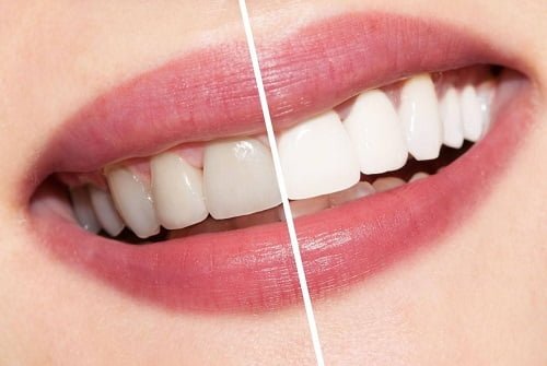 Tẩy trắng răng hút thuốc có sao không? Bác sĩ nha khoa trả lời 3