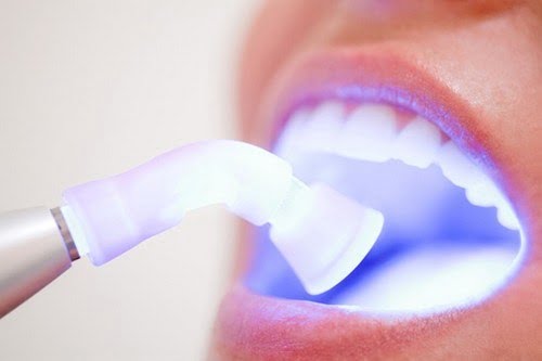 Tẩy trắng răng trong 1 tuần với cách làm nào? 1