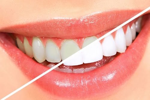 Tẩy trắng răng trong 1 tuần với cách làm nào? 2