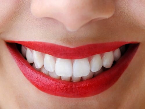 Có nên trồng răng sứ kim loại không? Giải đáp 2