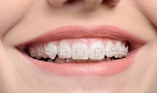 Niềng răng ăn uống như thế nào để có kết quả tốt? 1