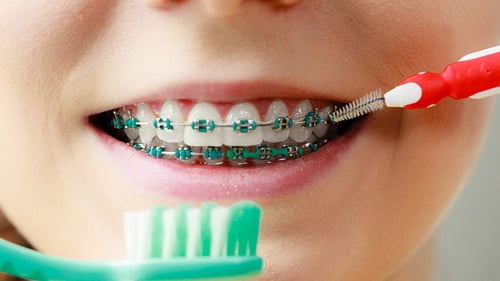 Cách khắc phục tình trạng niềng răng bị sưng lợi *
