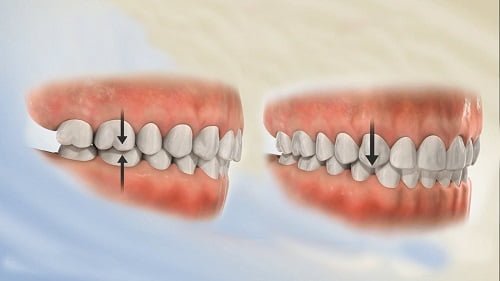 Niềng răng chỉnh hàm lệch có hiệu quả không? 2 Niềng răng chỉnh hàm lệch có hiệu quả không? 2