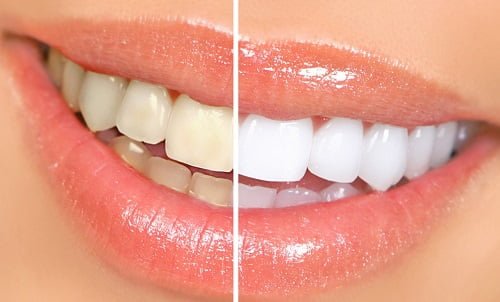 Tẩy trắng răng bằng than hoạt tính - Một cách làm phổ biến hiện nay 3