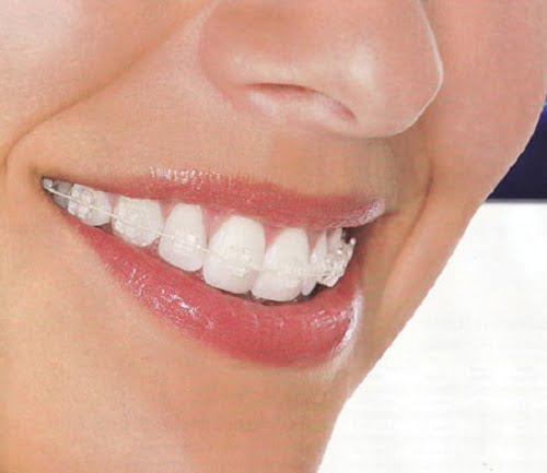 Tìm hiểu về niềng răng hô hàm trên *