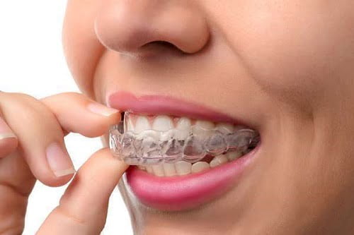 Niềng răng invisalign có nhổ răng không? Bác sĩ giải đáp 1 Niềng răng invisalign có nhổ răng không? Bác sĩ giải đáp 1