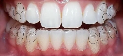 Niềng răng invisalign có nhổ răng không? Bác sĩ giải đáp 2