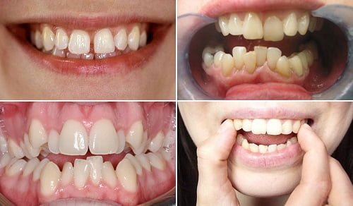 Niềng răng invisalign có nhổ răng không? Bác sĩ giải đáp 3