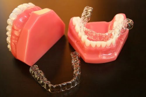 Niềng răng invisalign có nhổ răng không? Bác sĩ giải đáp 4
