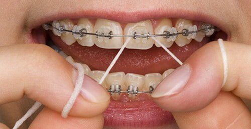 Niềng răng bị viêm lợi - Cách xử lý dứt điểm 1 Niềng răng bị viêm lợi - Cách xử lý dứt điểm 1