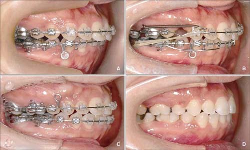 Niềng răng bị viêm lợi - Cách xử lý dứt điểm 2