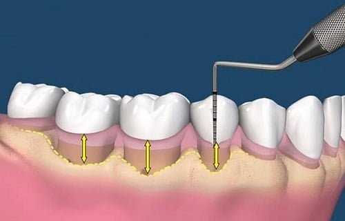 Niềng răng bị viêm lợi - Cách xử lý dứt điểm 3