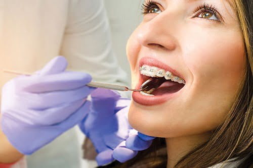 Niềng răng bị viêm lợi - Cách xử lý dứt điểm 4 Niềng răng bị viêm lợi - Cách xử lý dứt điểm 4