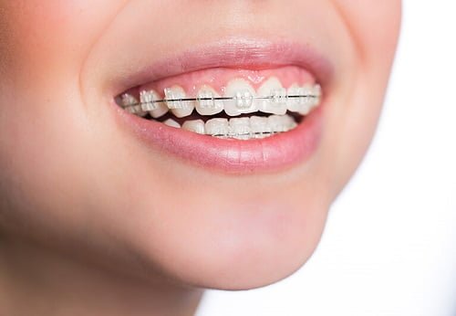 Niềng răng có nên dùng bàn chải điện? Giải đáp từ nha khoa 1