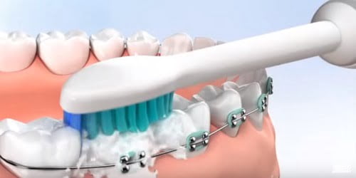 Niềng răng có nên dùng bàn chải điện? Giải đáp từ nha khoa 2